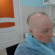 Стремительная алопеция Стремительная алопеция