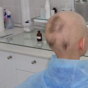 Лечение гнездной алопеции Лечение гнездной алопеции